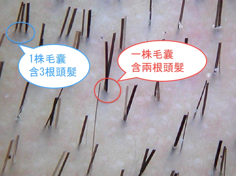 毛囊一根還是一株 20130605